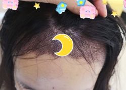 -大麦微针植发全国连锁