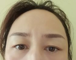 体验后-北京英煌医疗美容