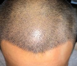 -大麦微针植发丨全国连锁