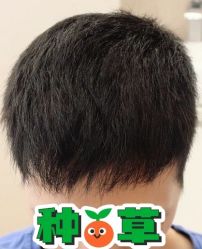 -大麦微针植发丨全国连锁