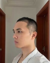 -大麦微针植发丨全国连锁