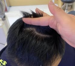 -大麦微针植发丨全国连锁