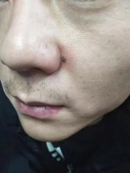 -北京美痣堂古方祛痣斑疣瘊