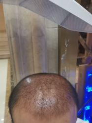 -碧莲盛·不剃发植发