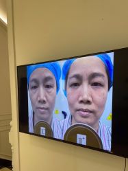-广州健丽·去眼袋医疗美容机构