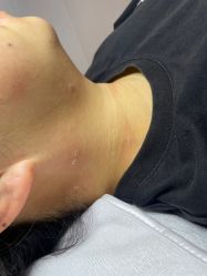 体验后-清疣美疣·痣·斑净肤中心