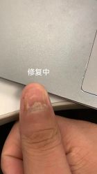 -德哥灰指甲脚气甲沟炎跖疣护理