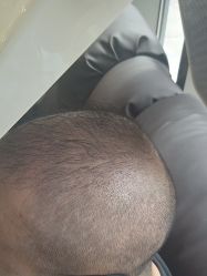 -碧莲盛·不剃发植发