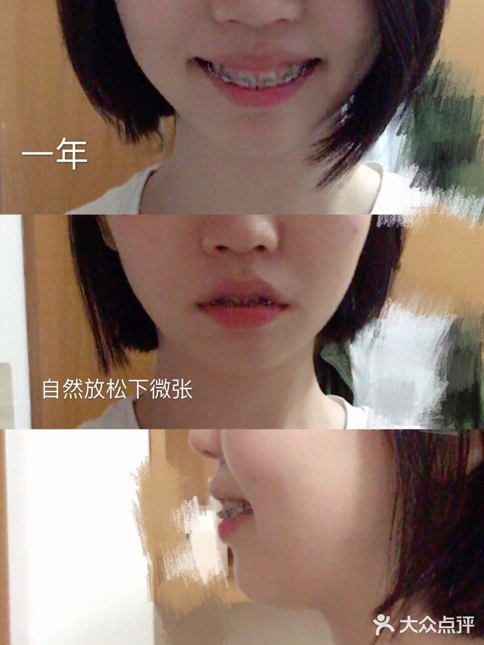 骨性深覆合金属自锁矫正案例 