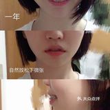 骨性深覆合金属自锁矫正案例 