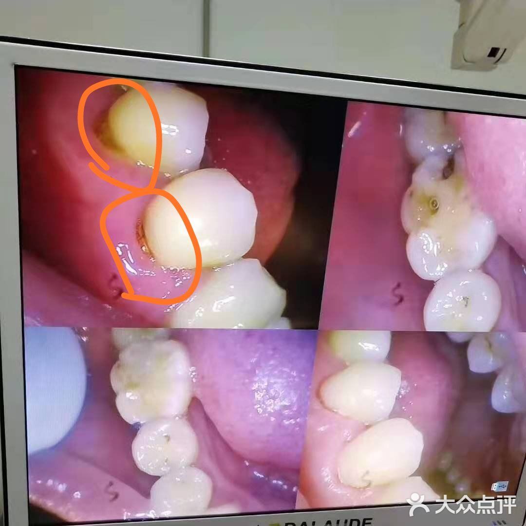 定期洁牙给你带来的意外和惊喜