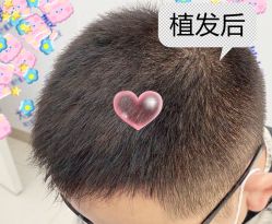 -大麦微针植发全国连锁