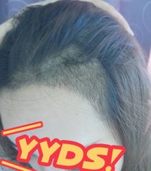 -大麦微针植发丨全国连锁