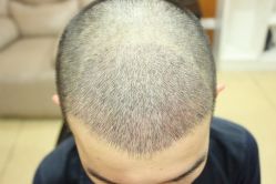 点击看大图 -大麦微针植发丨全国连锁