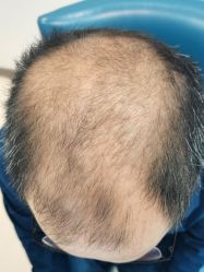 -大麦微针植发丨全国连锁