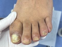 -Andrew指甲专科灰指甲·甲沟炎矫正·3D步态矫形鞋垫定制(浦三路店)