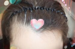 -大麦微针植发全国连锁