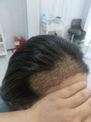 -大麦微针植发丨全国连锁