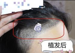 -大麦微针植发全国连锁