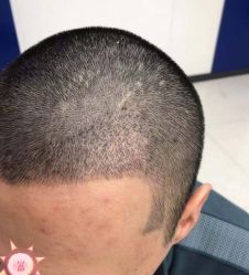 -大麦微针植发丨全国连锁