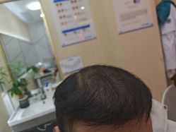 -碧莲盛·不剃发植发