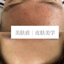 -美肤盾祛痘·问题肌头疗管理中心