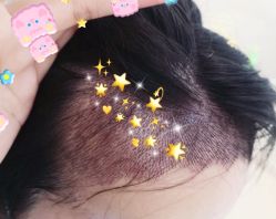 -大麦微针植发全国连锁