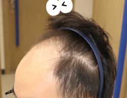 -大麦微针植发全国连锁