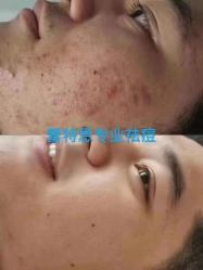 -蕾特恩专业祛痘·皮肤管理