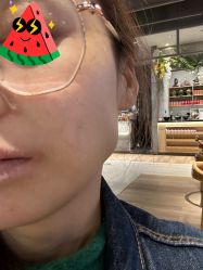 体验后-More摩尔医美の注射线雕光电中心