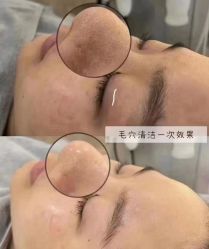 -瑶芳清颜草本祛痘