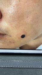 -痣斑堂·取大痣