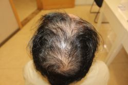 -大麦微针植发丨全国连锁