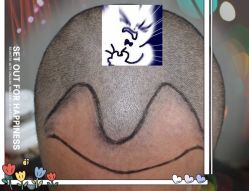 -大麦微针植发全国连锁