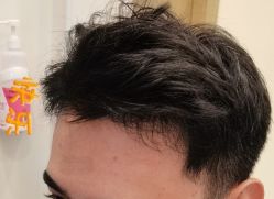 -大麦微针植发丨全国连锁