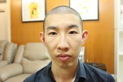 点击看大图 -大麦微针植发丨全国连锁