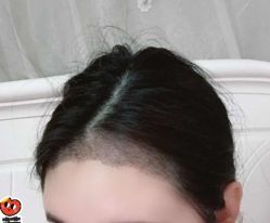 -大麦微针植发丨全国连锁