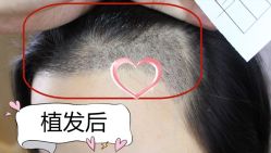 -大麦微针植发丨全国连锁