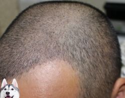 -大麦微针植发丨全国连锁