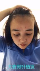 点击看大图 -大麦微针植发丨全国连锁