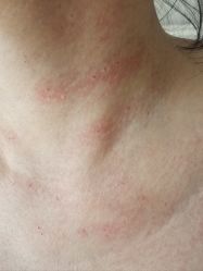 -爱莎扁平疣·汗管瘤·斑痣中心