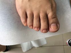 -德哥灰指甲脚气甲沟炎跖疣护理