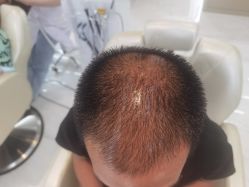 -大麦微针植发丨全国连锁