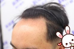 点击看大图 -大麦微针植发丨全国连锁