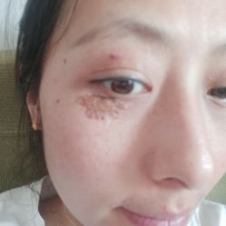 -爱莎扁平疣·汗管瘤·斑痣中心