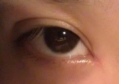 拆线第一天-上海华安整形外科门诊部