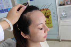 -大麦微针植发丨全国连锁