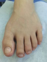 -德哥灰指甲脚气甲沟炎跖疣护理