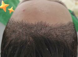 -大麦微针植发丨全国连锁