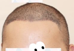 -大麦微针植发全国连锁